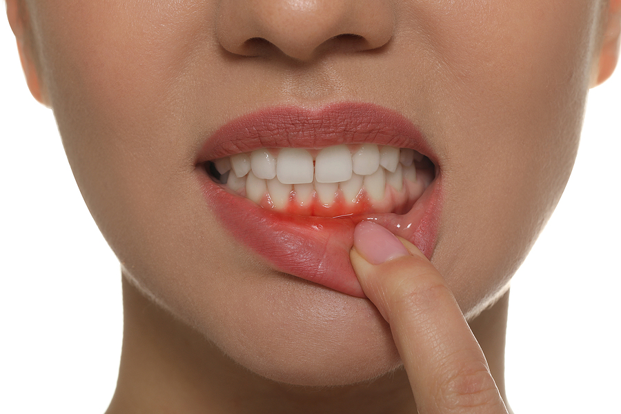 Main Causes of Gum Disease