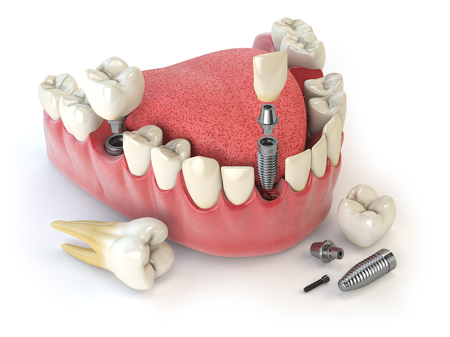 Exploring the Benefits of Implant Dentures: A Solution for Lasting Comfort and Function in Salt Lake, UT